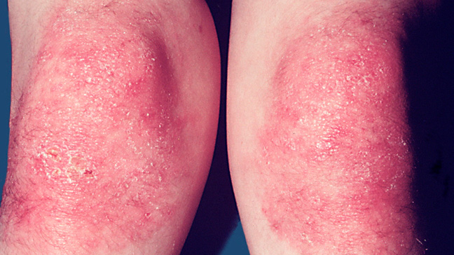 immune system rash deases